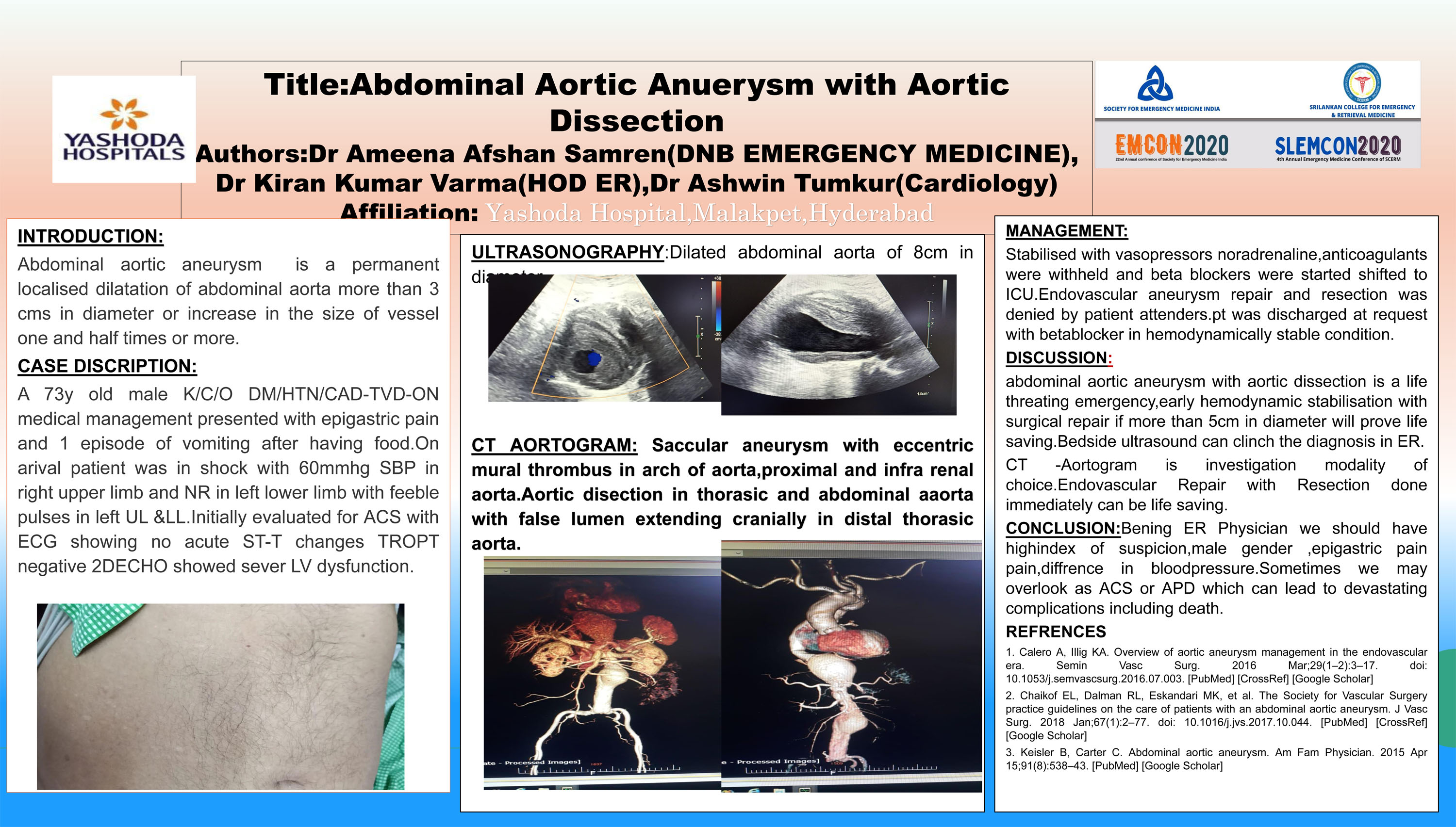PP20 – Abdominal Aortic Anuerysm with Aortic Dissection
