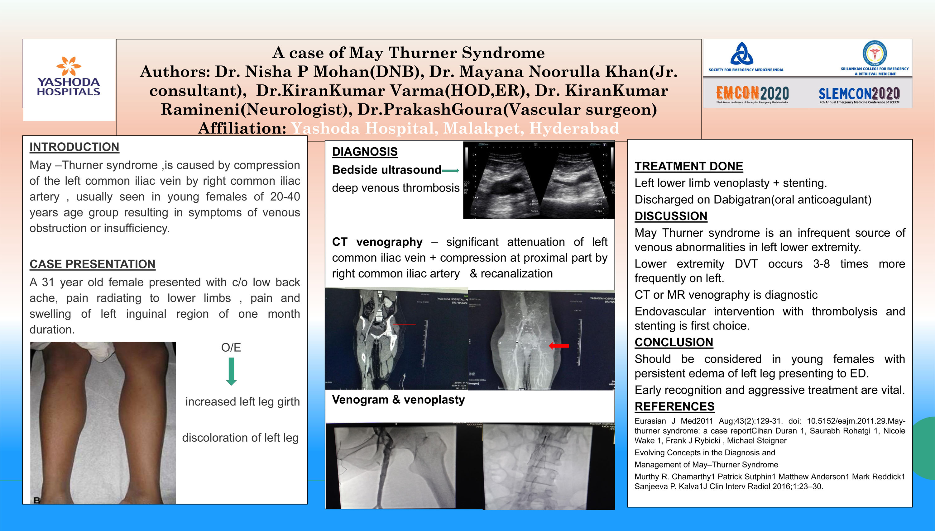 PP21 – A case of May Thurner Syndrome