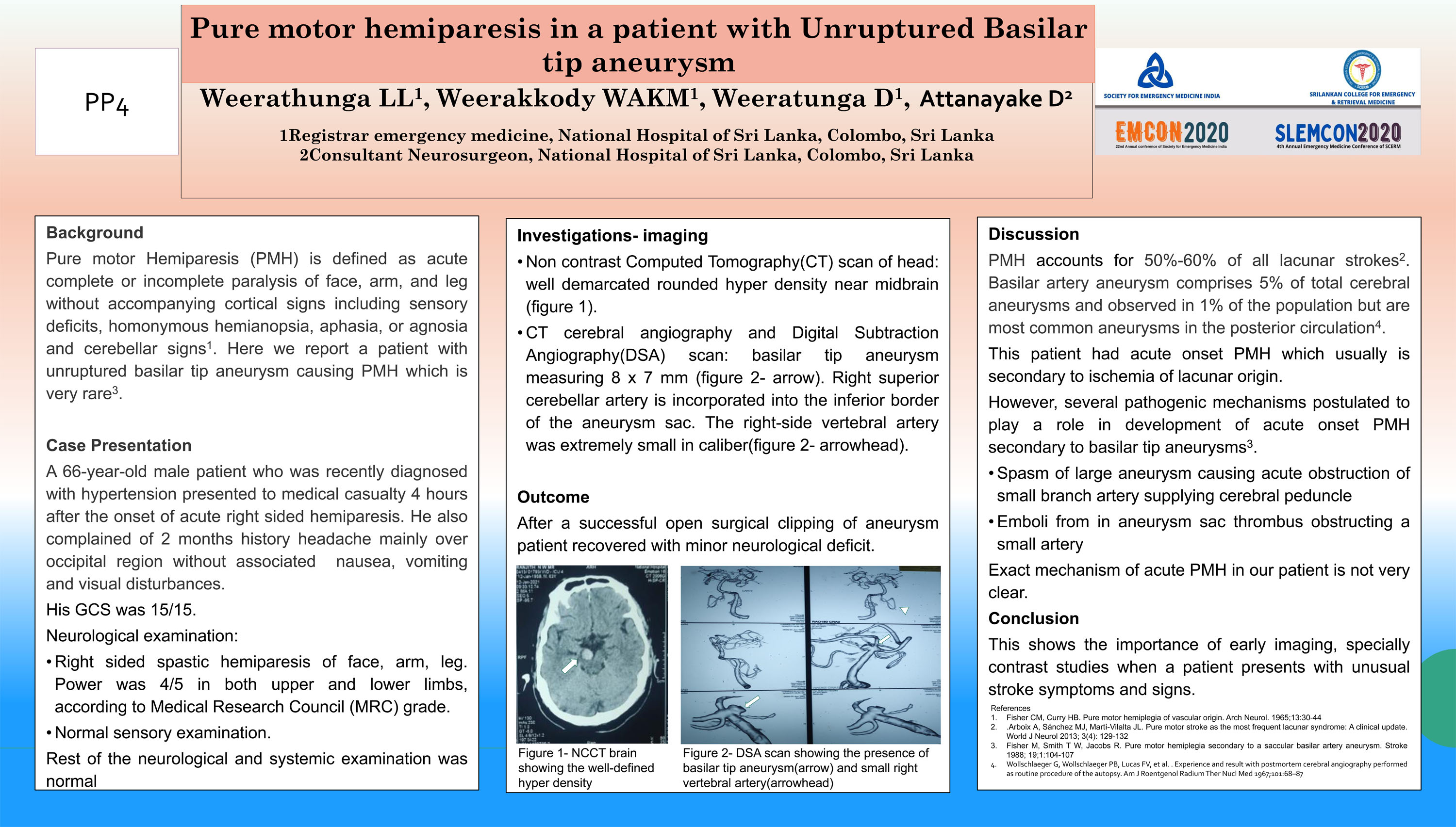 PP4 – Pure motor hemiparesis in a patient with Unruptured Basilar tip aneurysm