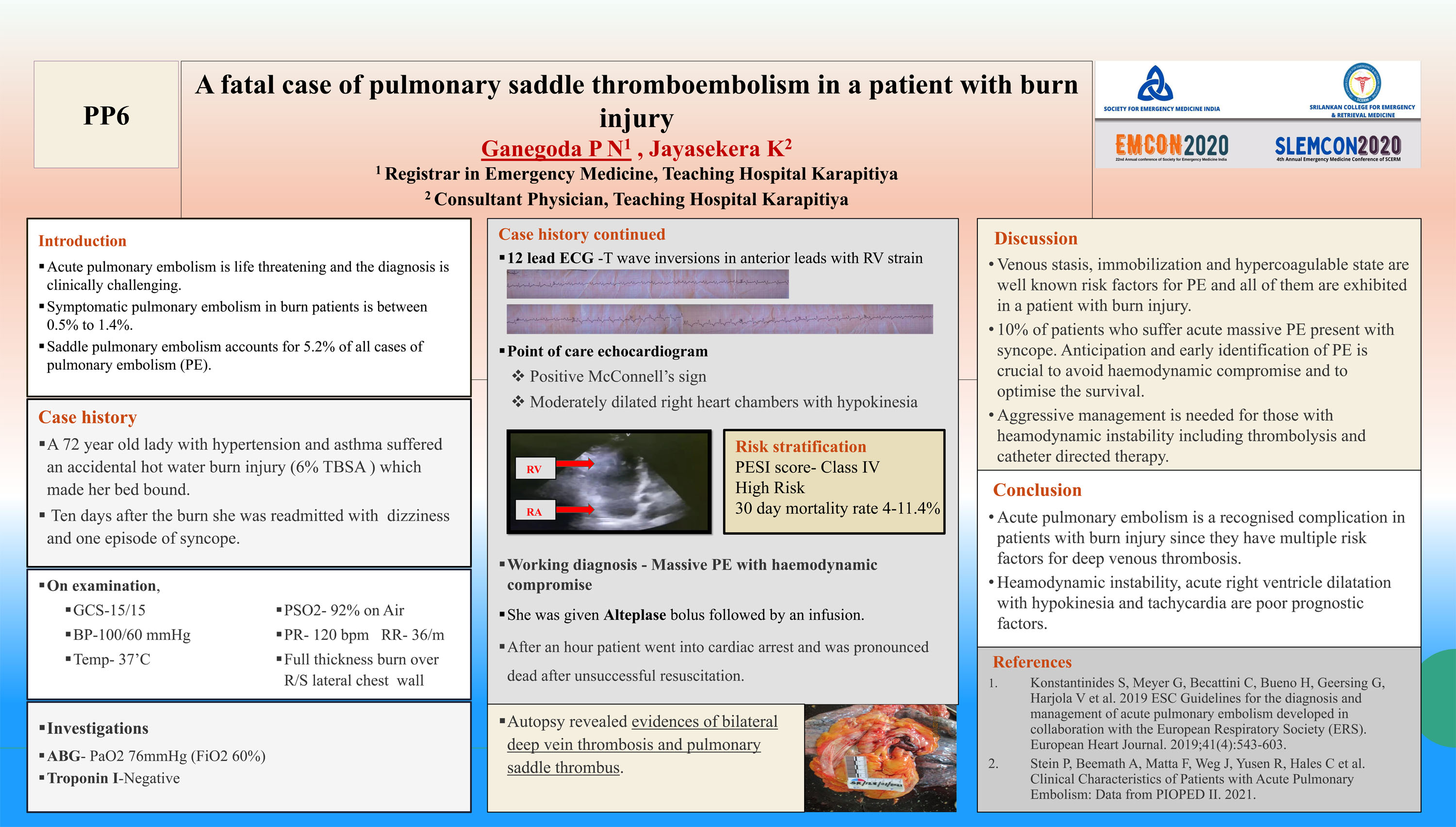 PP6 – A fatal case of pulmonary saddle thromboembolism in a patient with burn injury